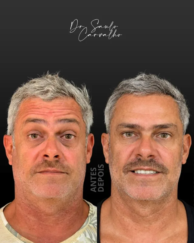 Antes e depois: Botox Full Face