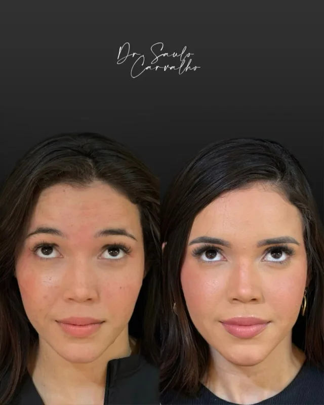 Antes e depois: Botox Full Face