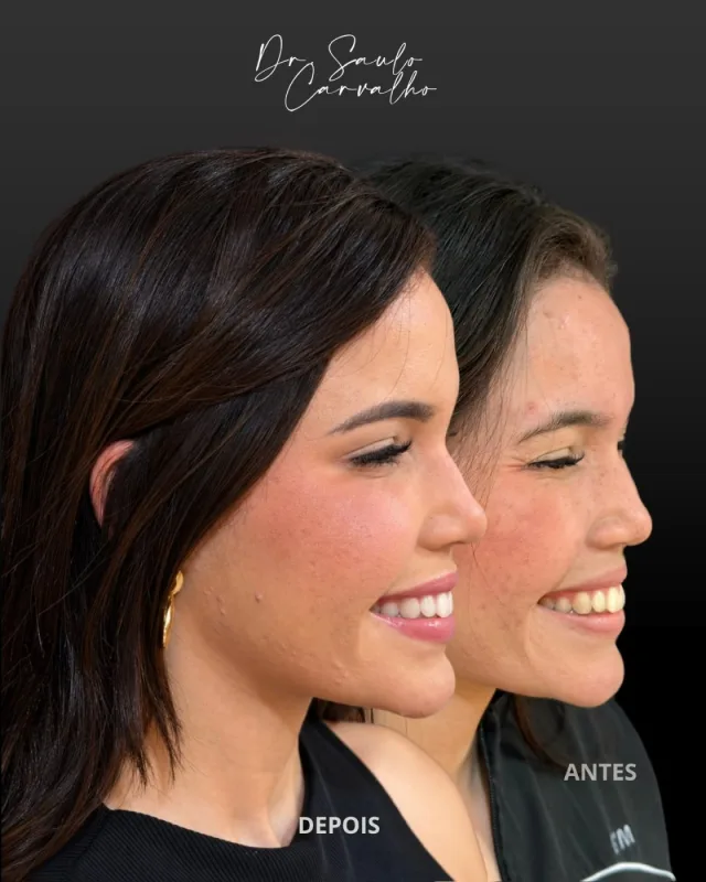 Antes e depois: Botox Full Face