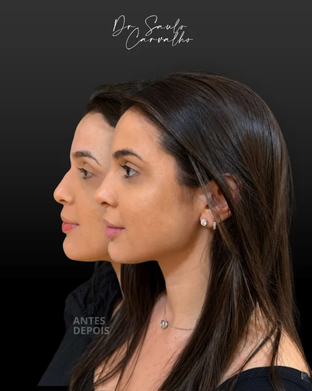 Antes e depois: Perfiloplastia