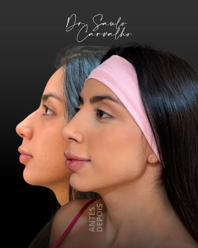 Antes e depois: Perfiloplastia