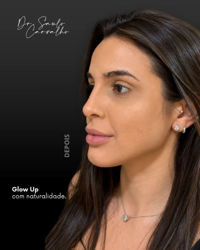 Antes e depois: Perfiloplastia