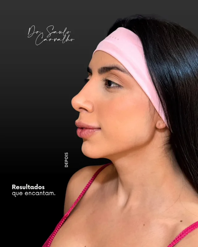 Antes e depois: Perfiloplastia