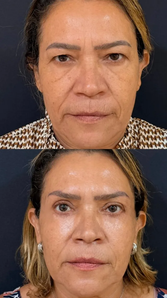 Antes e depois: Blefaroplastia + Preenchimento Full Face