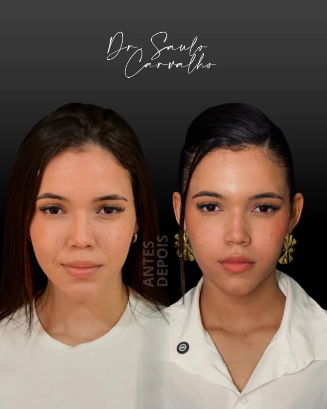 Antes e depois: Harmonização facial