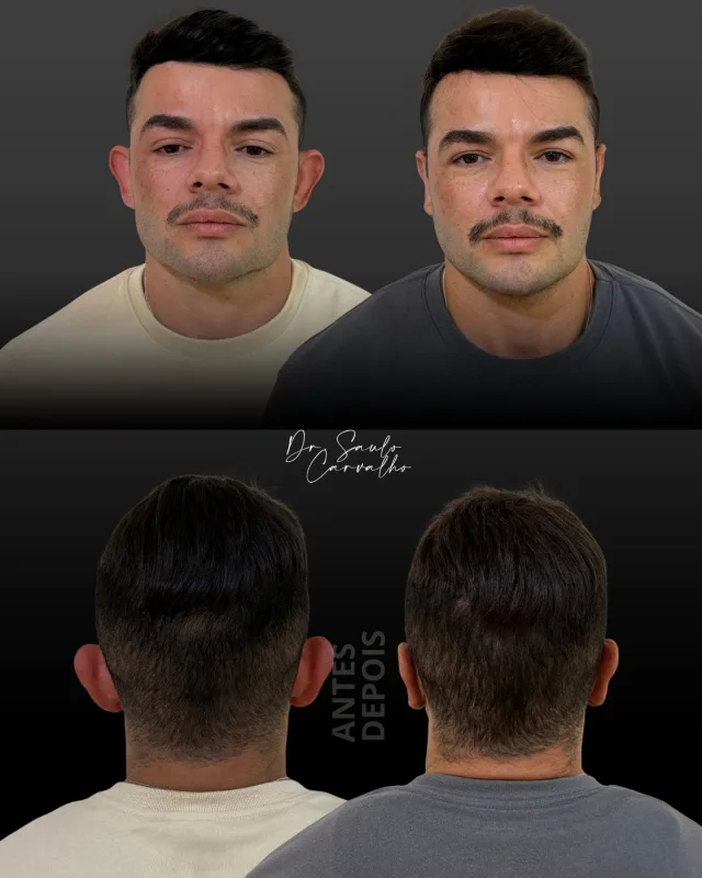 Antes e depois: Otoplastia