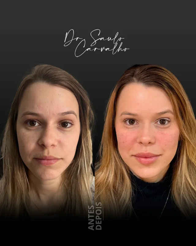 Antes e depois: Harmonização facial