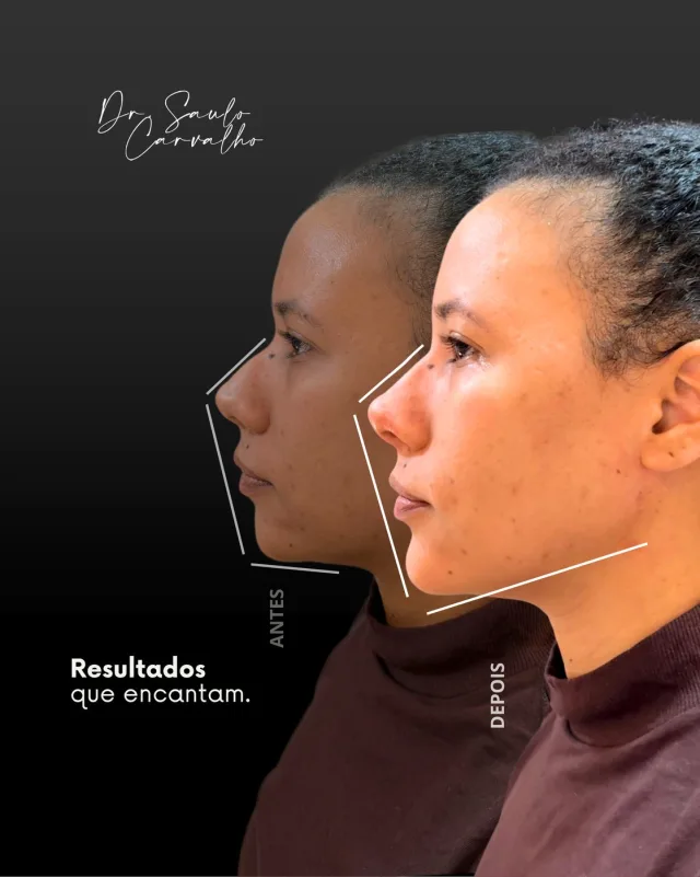 Antes e depois: Contorno mandibular e perfil