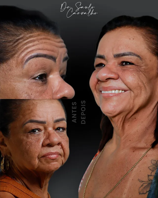 Antes e depois: Toxina botulínica e rejuvenescimento