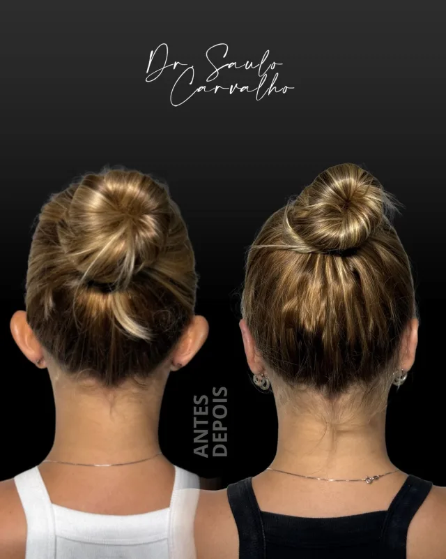 Antes e depois: Otoplastia