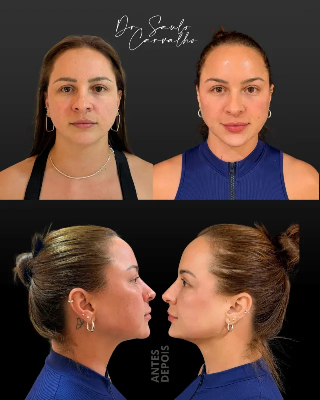 Antes e depois: Harmonização facial