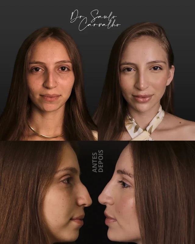 Antes e depois: Rinomodelação e lábios