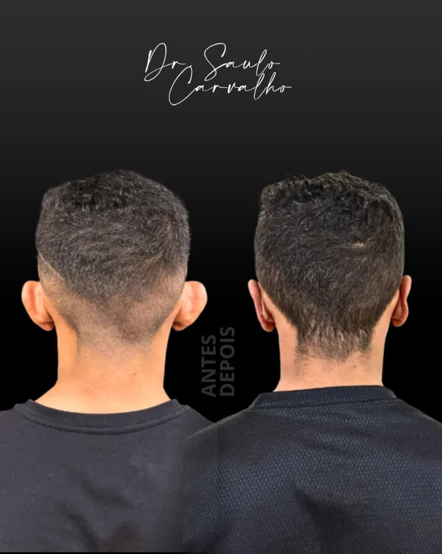 Antes e depois: Otoplastia